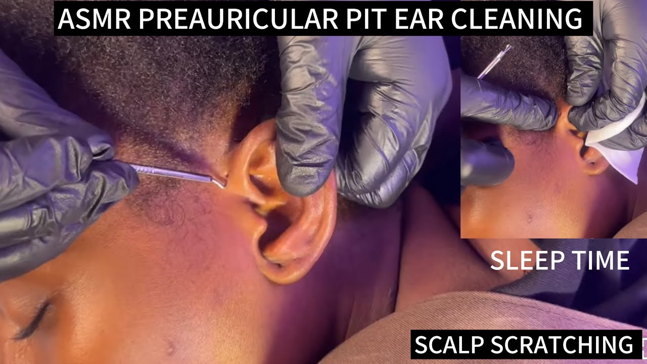 ASMR PREAURICULAR PIT CLEANING, EAR CLEANING AND NITPICKING FOR SLEEP VERY RELAXING