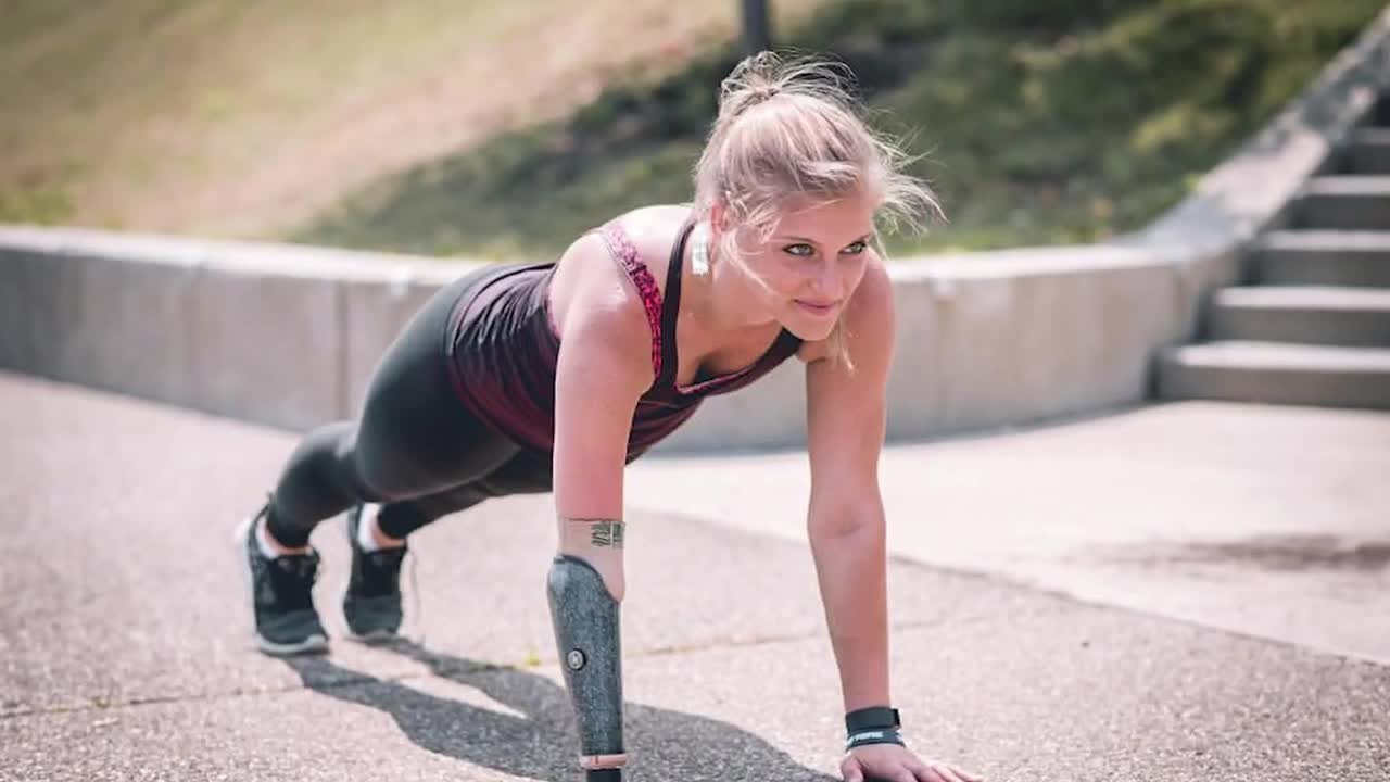 Deanna's Story | Amniotic Band Syndrome