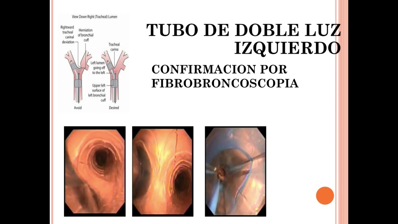 INTUBACION SELECTIVA. PERLAS EN ANESTESIA 15