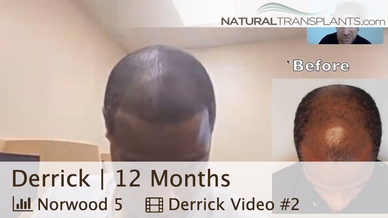 Hair Transplant Results After 12 Months | Hair Transplant Results Black Man (Derrick)