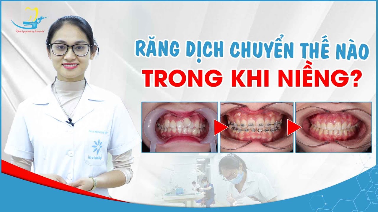 Răng thay đổi như thế nào trong quá trình niềng răng || Cơ chế di chuyển của răng