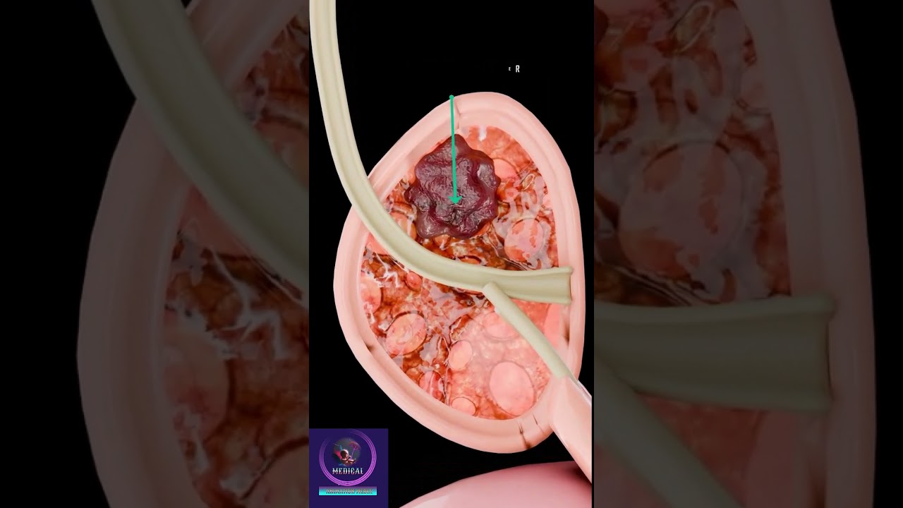 Что такое рак предстательной железы? &mdash; краткое объяснение
