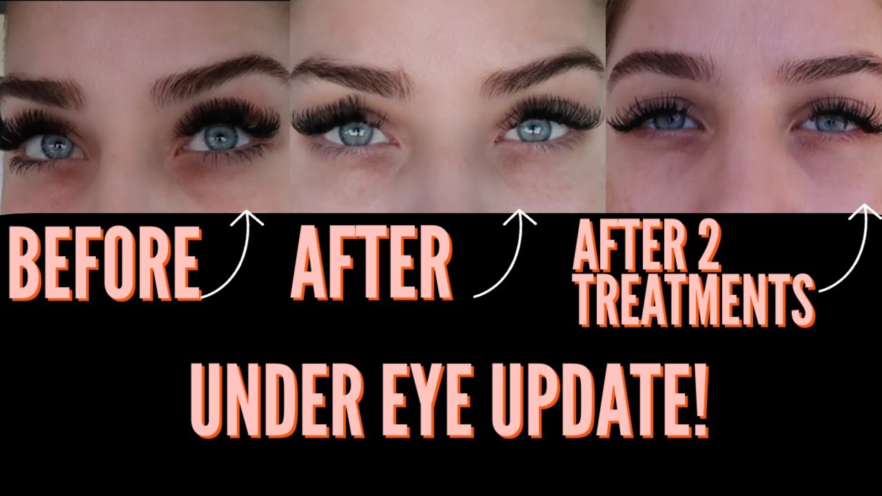 MICRONEEDLING WITH PRP BEFORE AND AFTER//GET RID OF DARK CIRCLES & VOLUME LOSS! MY 1 YEAR UPDATE!