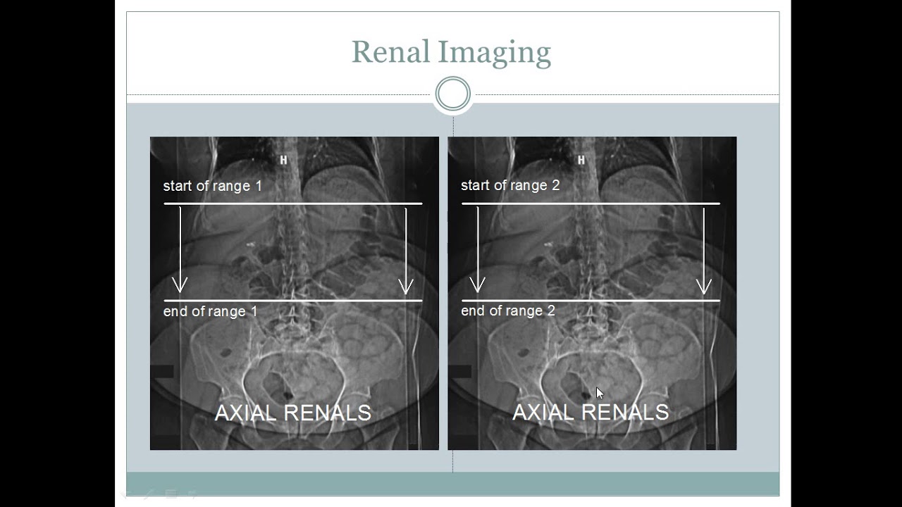 CT Scan Abdomen