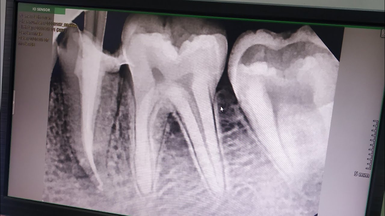 Single sitting RCT or Multiple sitting RCT? Which is better