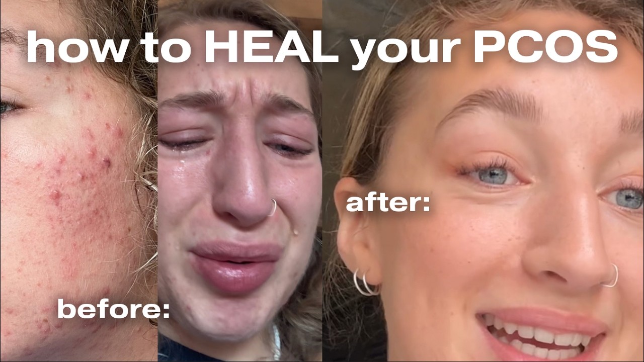 HOW I healed my PCOS (acne, anxiety, depression, moon face)