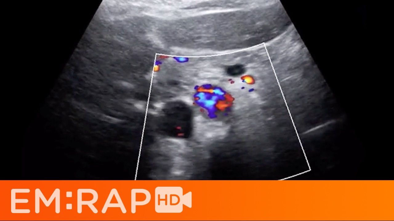 Ultrasound of Aortic Dissection