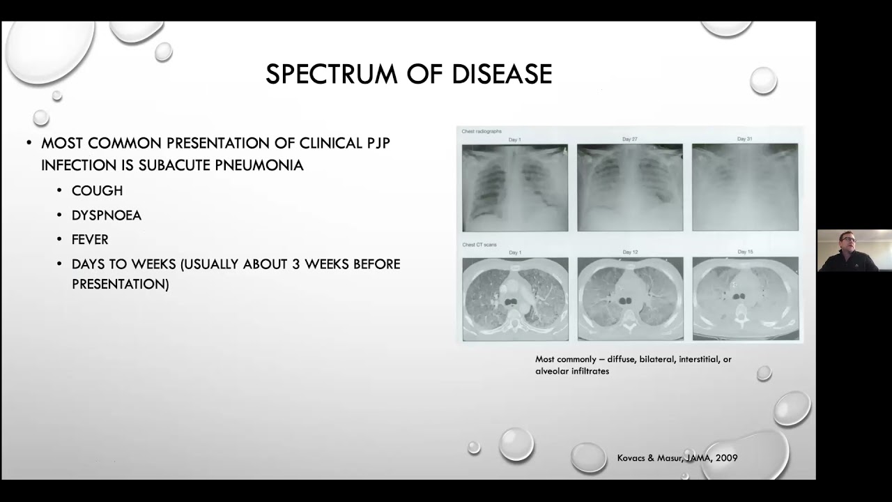 Pneumocystis jirovecii pneumonia - Current Issues in its Management