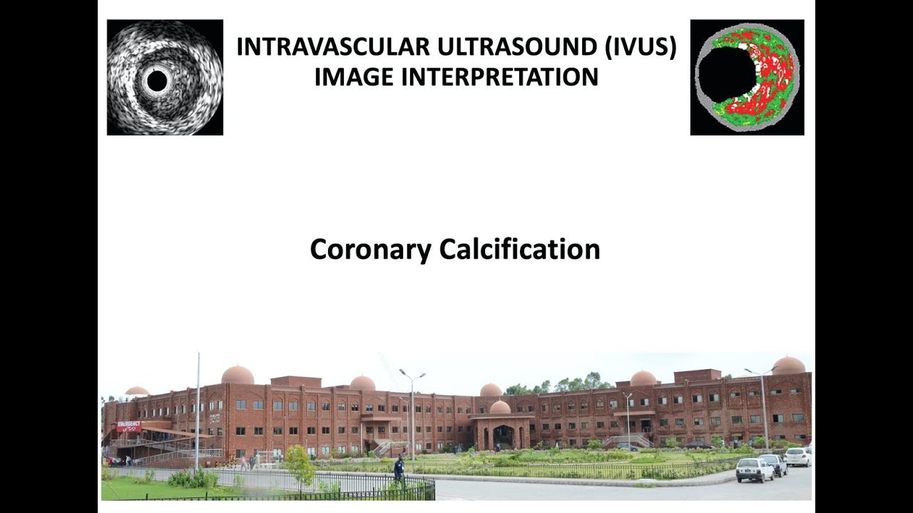 5. IVUS in Coronary Calcification