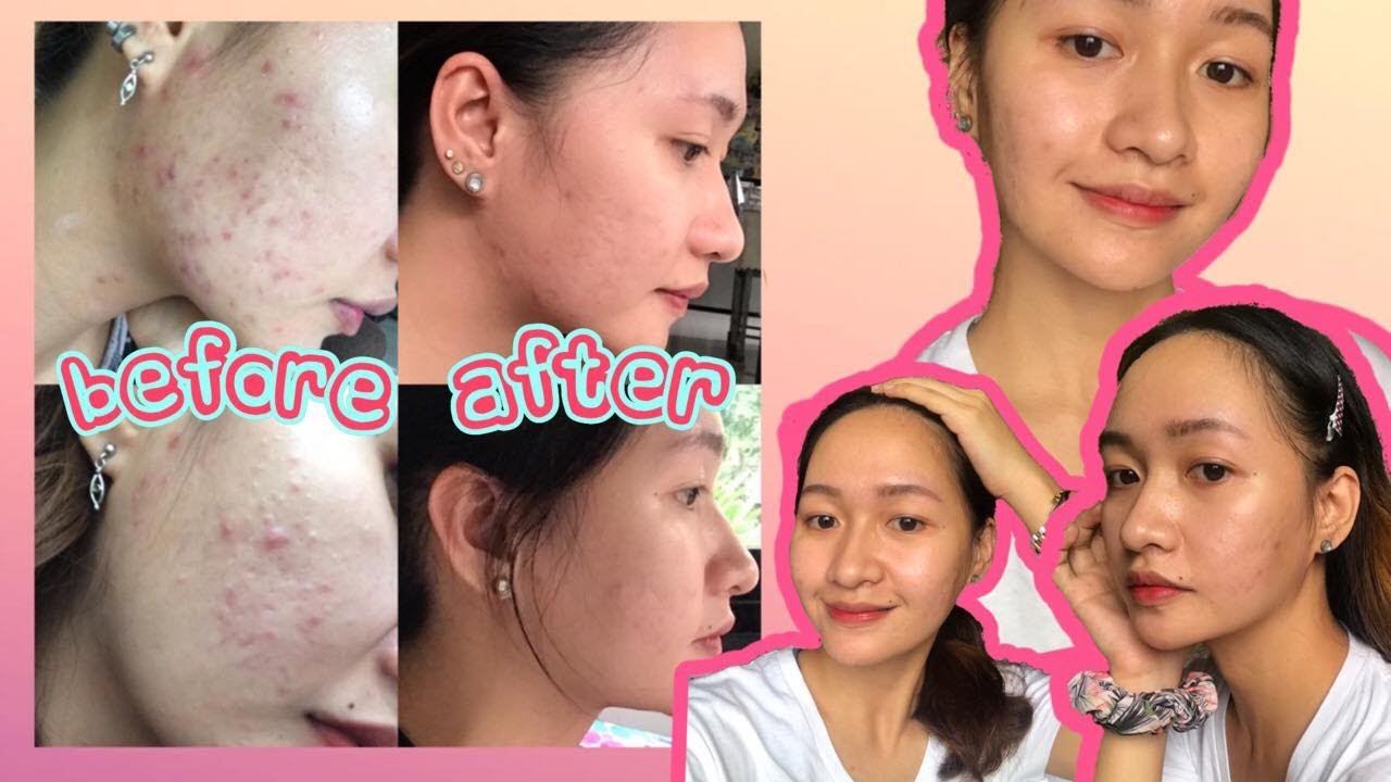 HOW I GOT RID OF ACNE BREAKOUTS/ My Acne Story/6Natural Remedies to Avoid ACNE BREAKOUTS/PHILIPPINES