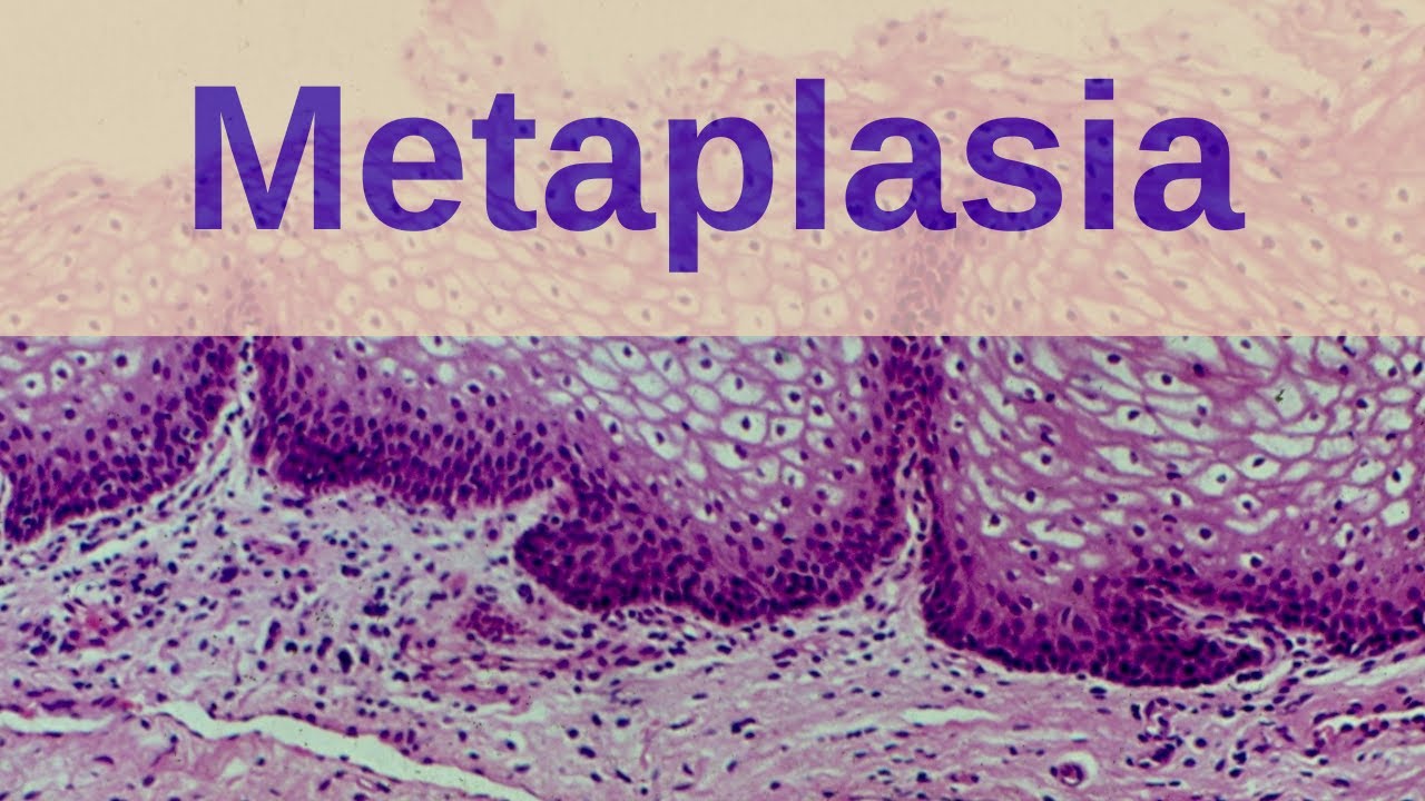 What is Metaplasia? - Pathology mini tutorial