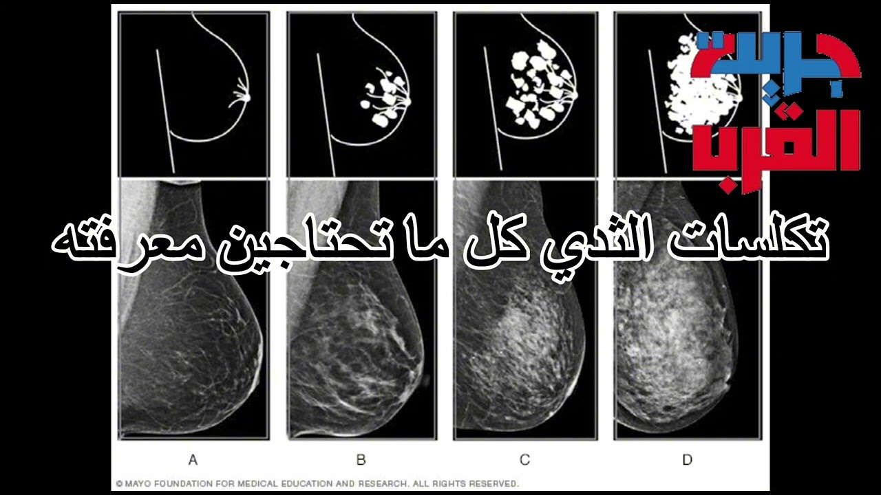 تكلسات الثدي كل ما تحتاجين معرفته