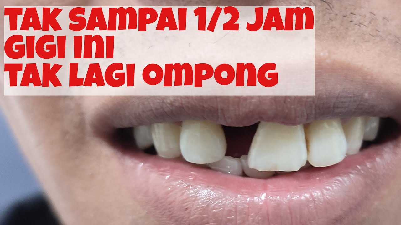 pembuatan gigi palsu permanen secara langsung (temporary maryland composite bridge anterior)