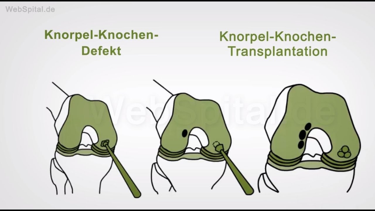 Diagnostik und Knorpel-Knochen-Transplantation bei Arthrose