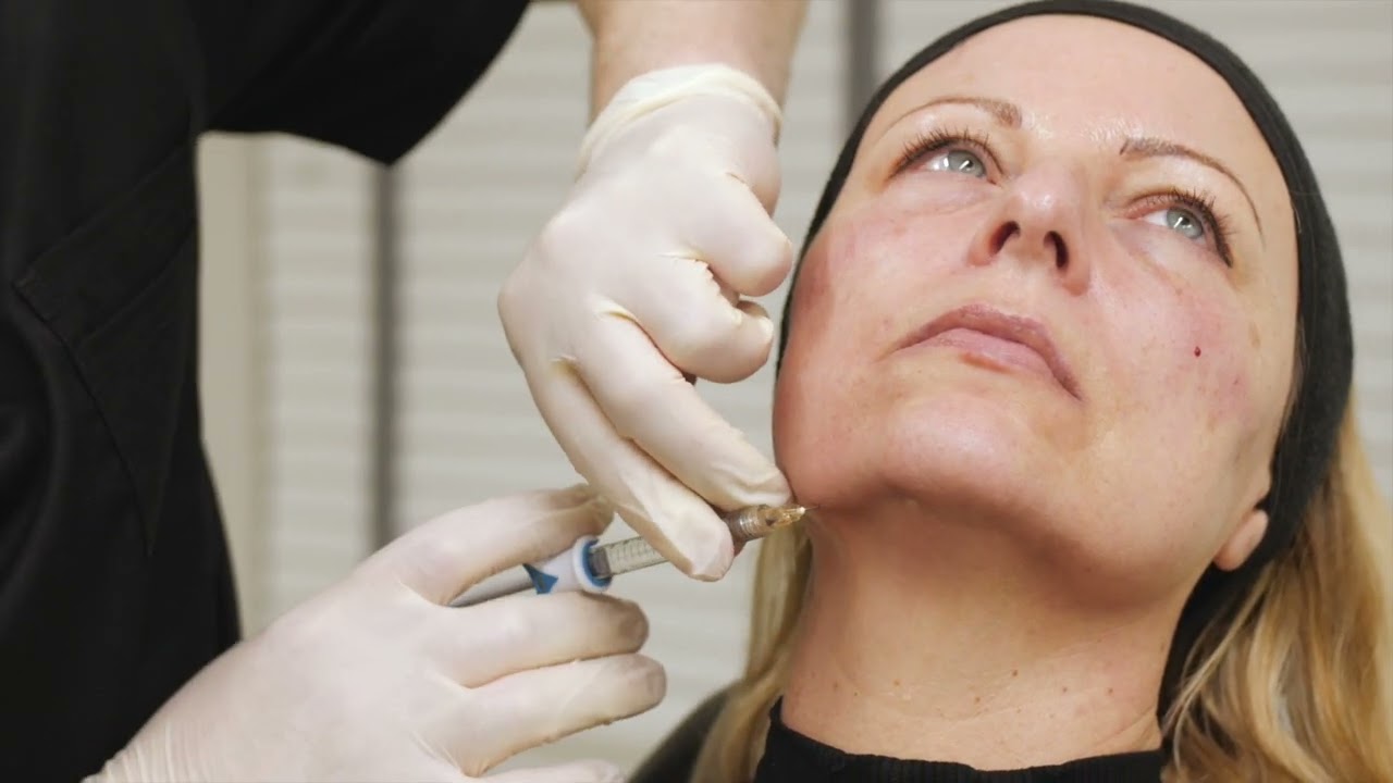 Correction of jowls with filler at the chin