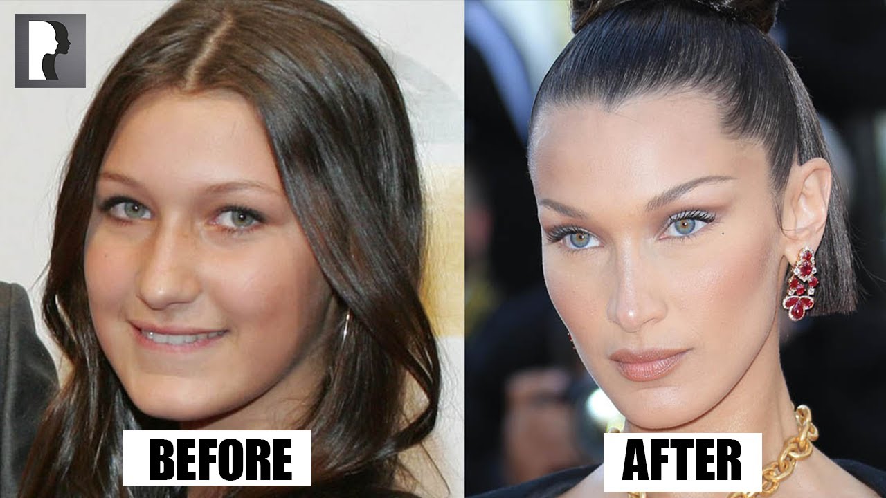 Bella Hadid Admits She REGRETS Her Nose Job! - Dr. Julian De Silva
