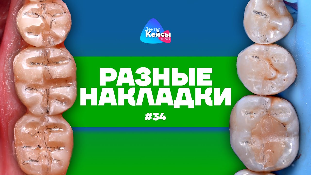Разные накладки | Дентал Кейсы от BG #34