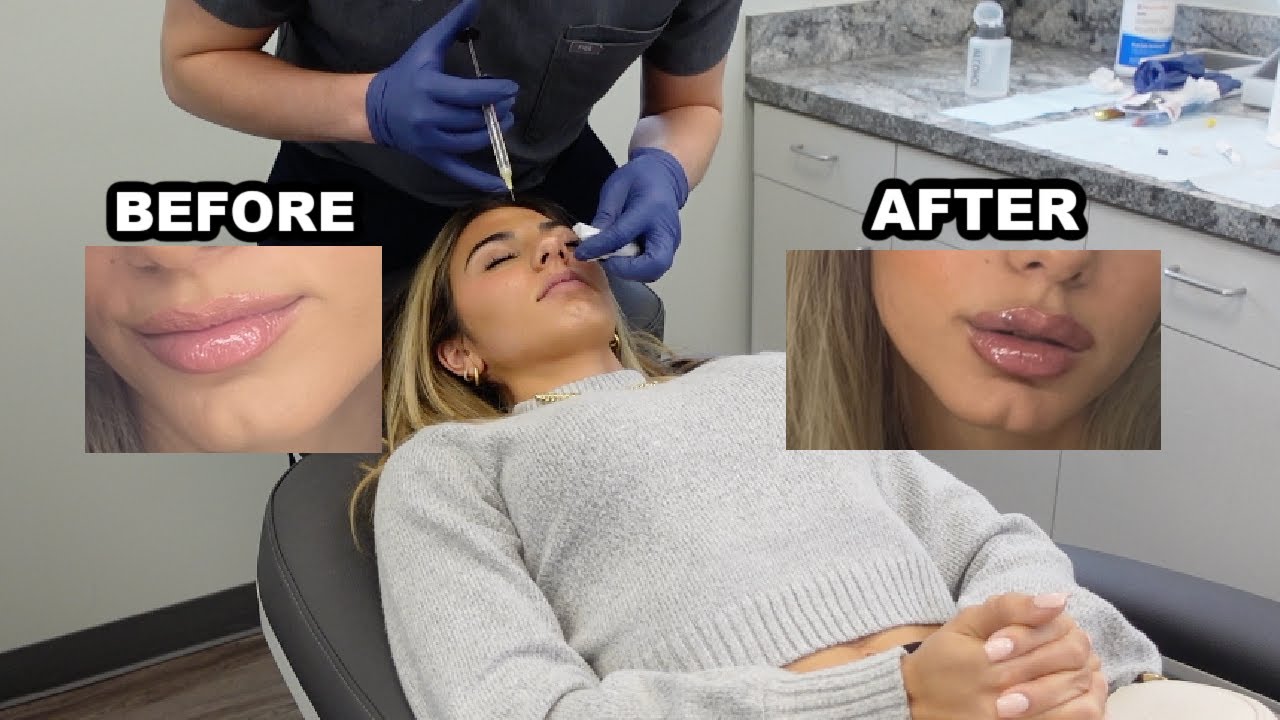 GETTING LIP FILLER AND BOTOX FOR THE FIRST TIME!