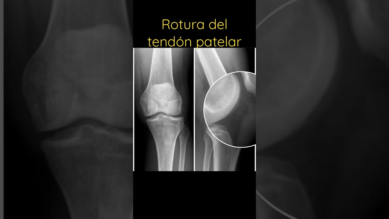 Rótula alta en rotura completa 