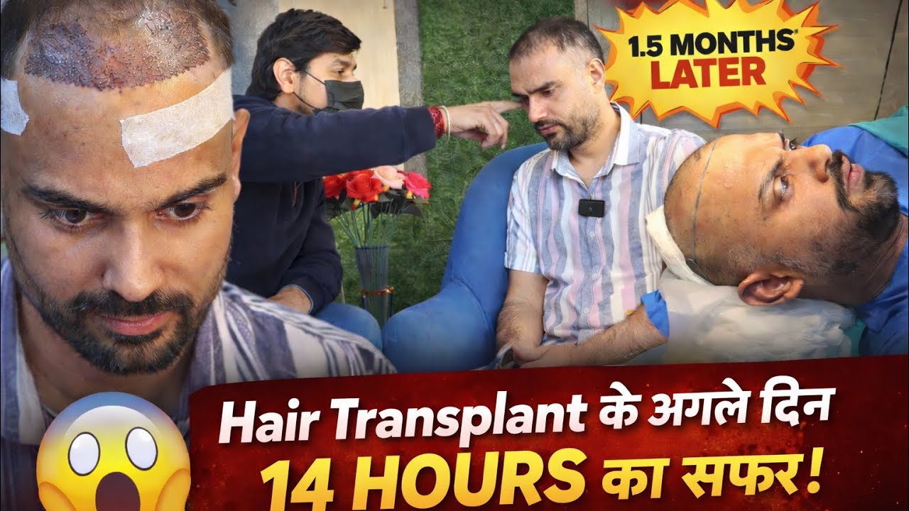 Shedding phase तक का  Experience || गंजापन 🧑‍🦲 होगा खत्म !