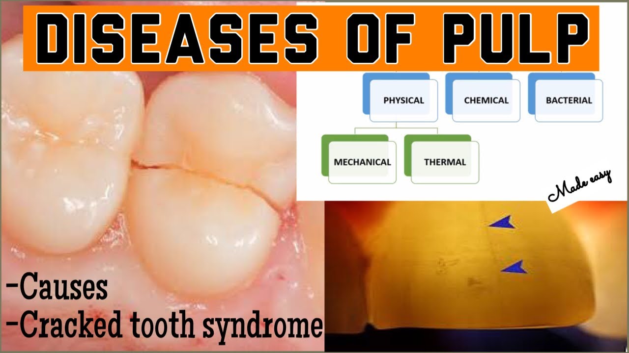 DISEASES OF THE PULP II CAUSES II CRACKED TOOTH SYNDROME II PULPAL DISEASE SERIES (part-1) II imp