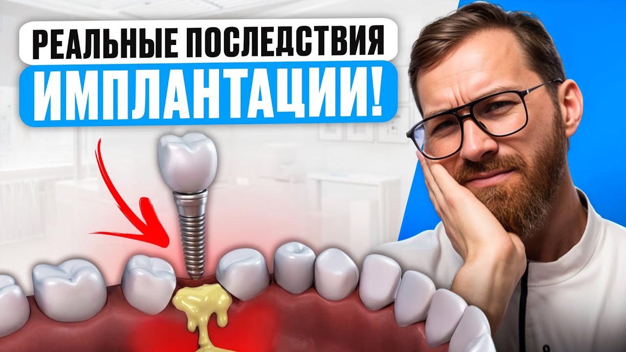 Самые ЧАСТЫЕ ПОСЛЕДСТВИЯ после Имплантации ЗУБОВ - Как уберечь СЕБЯ от ЭТОГО?