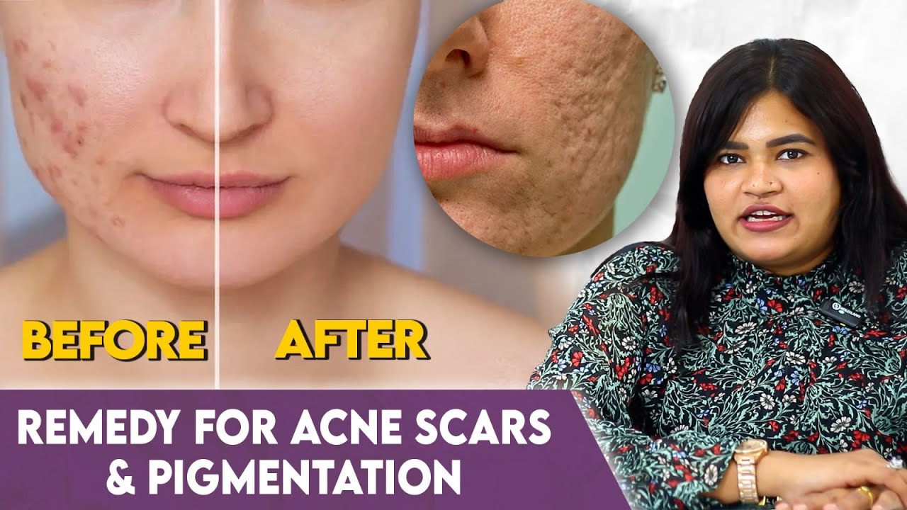Acne Scars வராம இருக்க இத பண்ணுங்க! - Dr Radha Explains | Best Acne Scar Treatments | Pigmentation