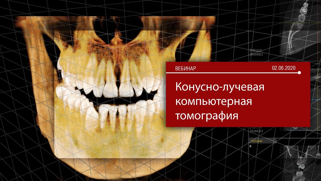Конусно-лучевая компьютерная томография