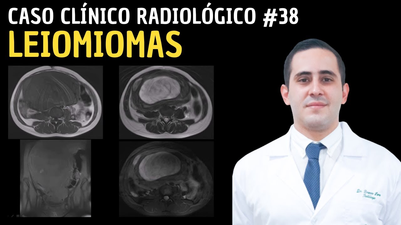 Caso Clínico Radiológico 38: Leiomiomas.