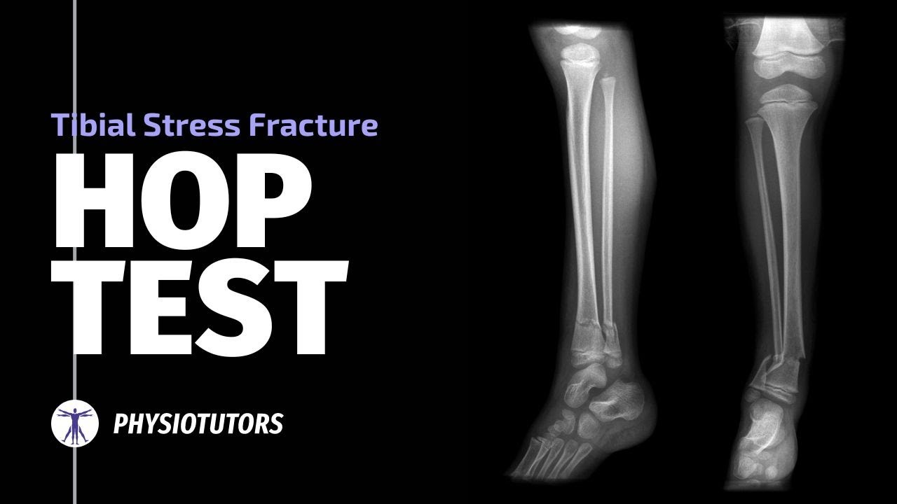 Hop Test | Tibial Stress Fractures
