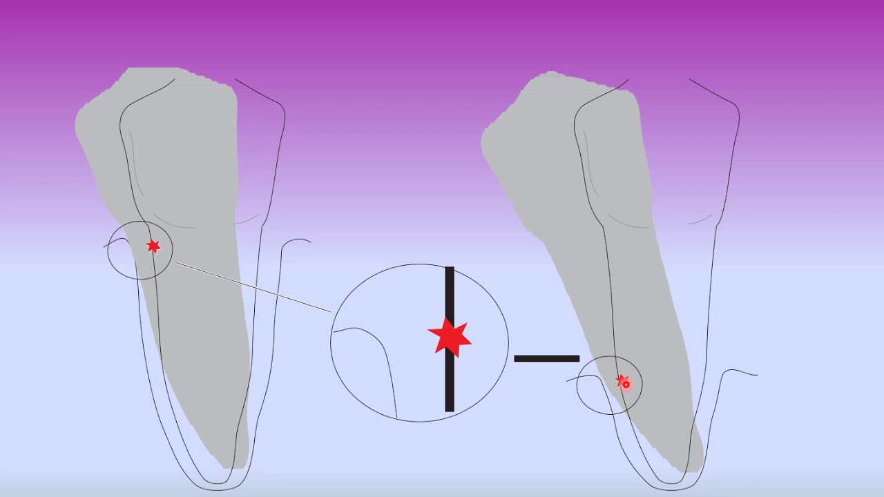 tooth mobility Part 1