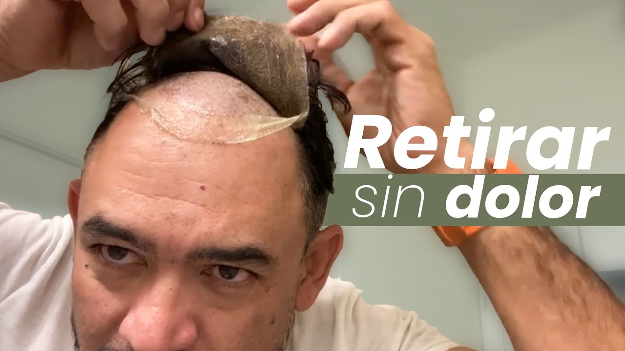 ¿Cómo quitar una prótesis capilar SIN DOLOR?!