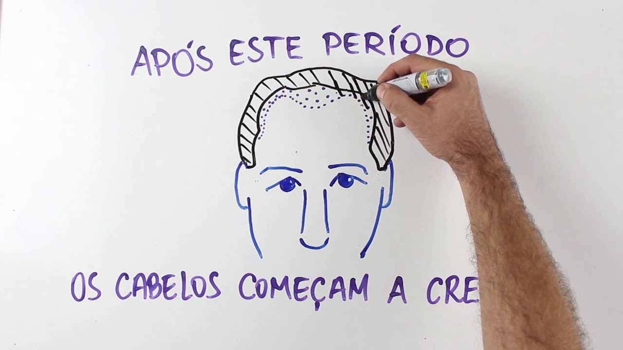 Implante Capilar Técnica FUE e FUT - O que é, Como Funciona - iCB Implante Capilar