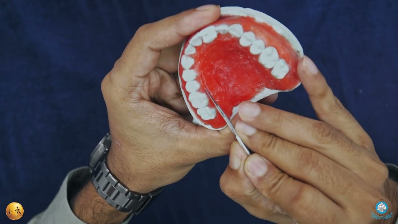 Free Gingival Graft II MGMDCH