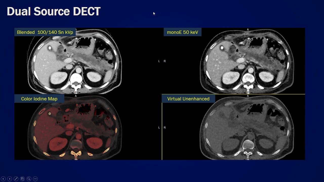 Dual energy CT abdomen