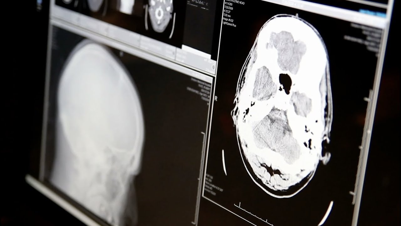 Two new treatments for Glioblastoma | The Check Up