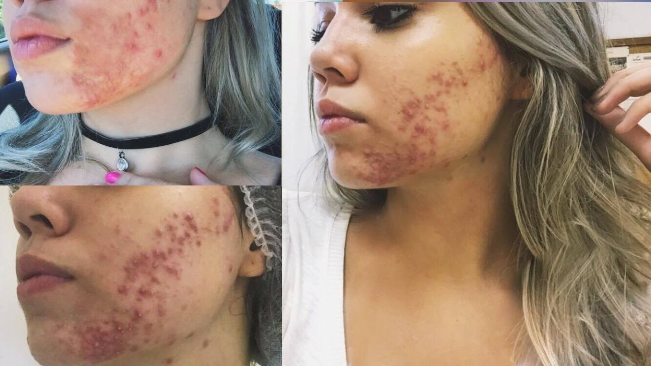 O que aconteceu com o meu rosto? O verdadeiro motivo de tanta acne - Julyanne Nascimento