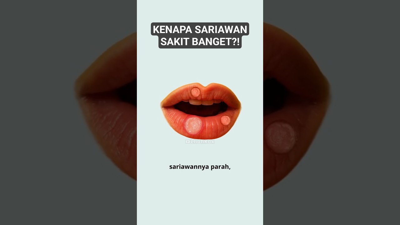 Kenapa Sariawan Sakit Banget? - Lhoh Kok?