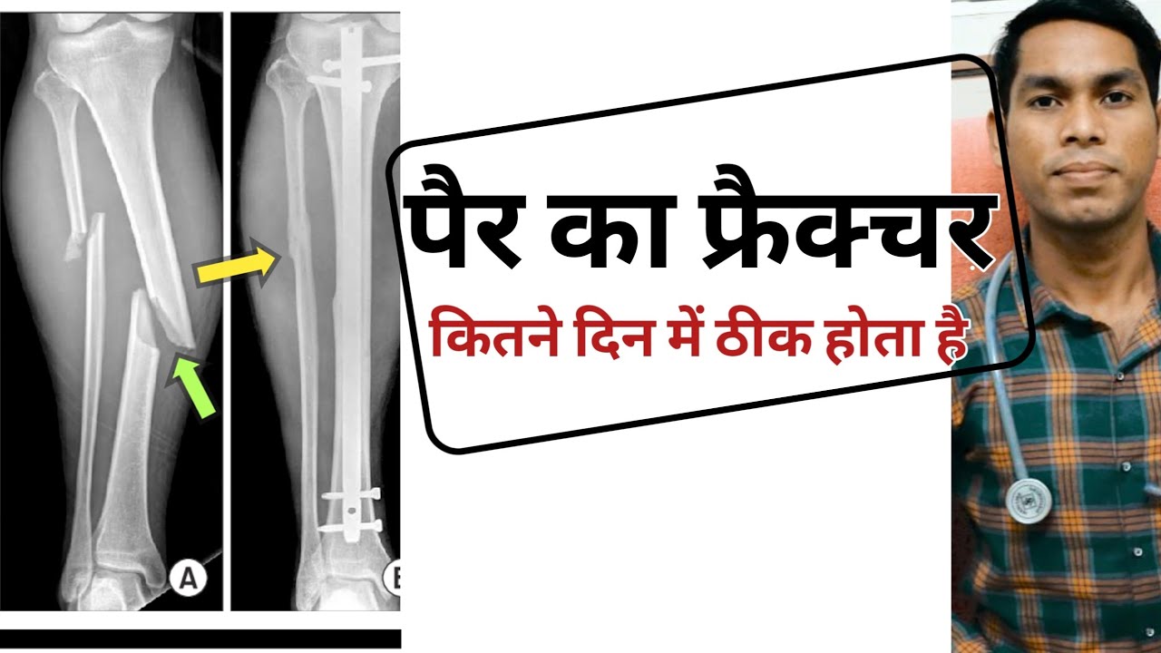 Pair ki haddi kitne din mein jud jati hai, tibia fibula fracture kitne din me thik hota, kaise judti
