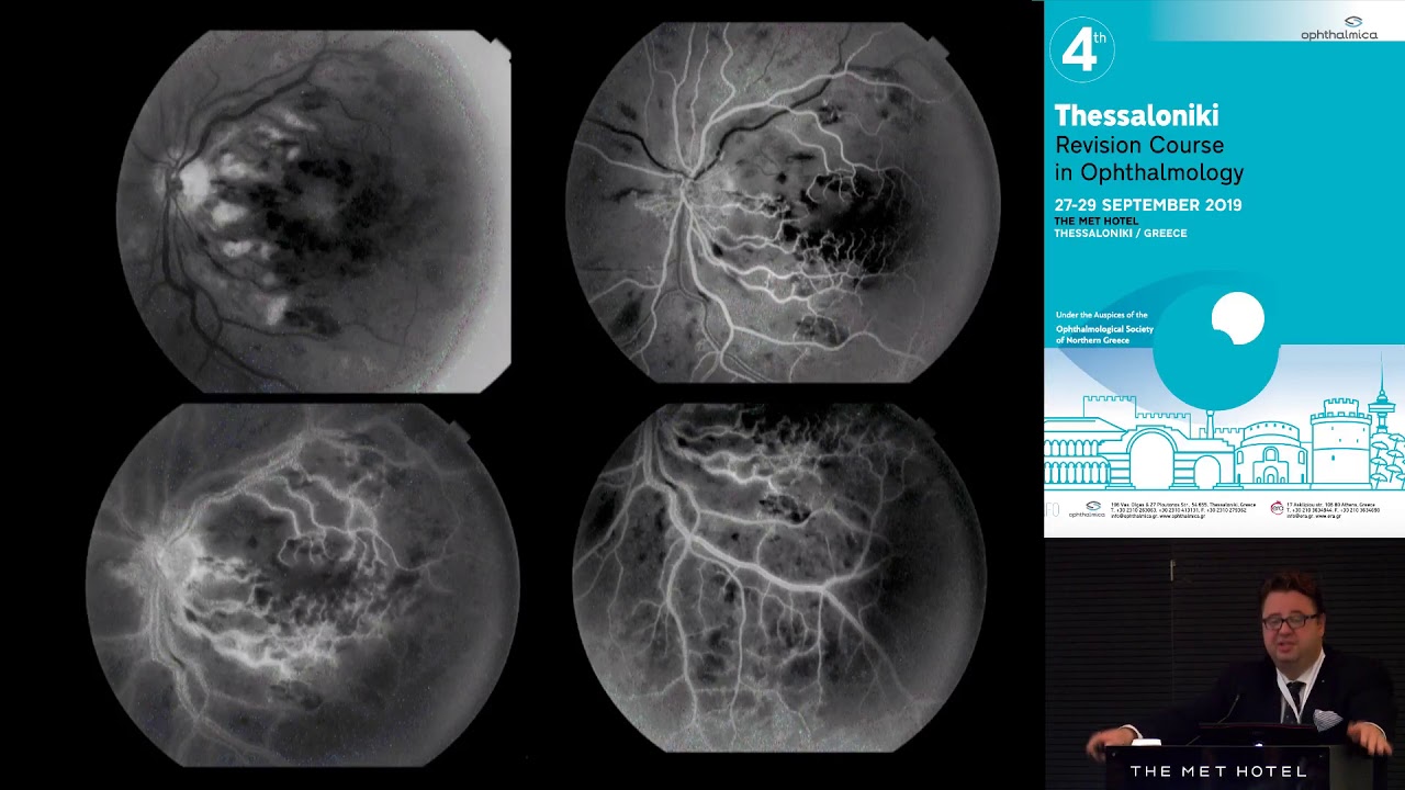 T. Rotsos | Retinal vein occlusions