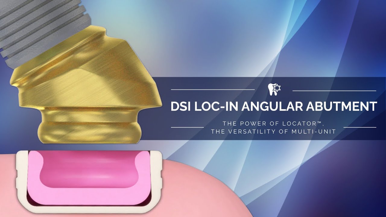 Loc-in Angular Abutment - the most versatile overdenture attachment - up to 80 deg correction