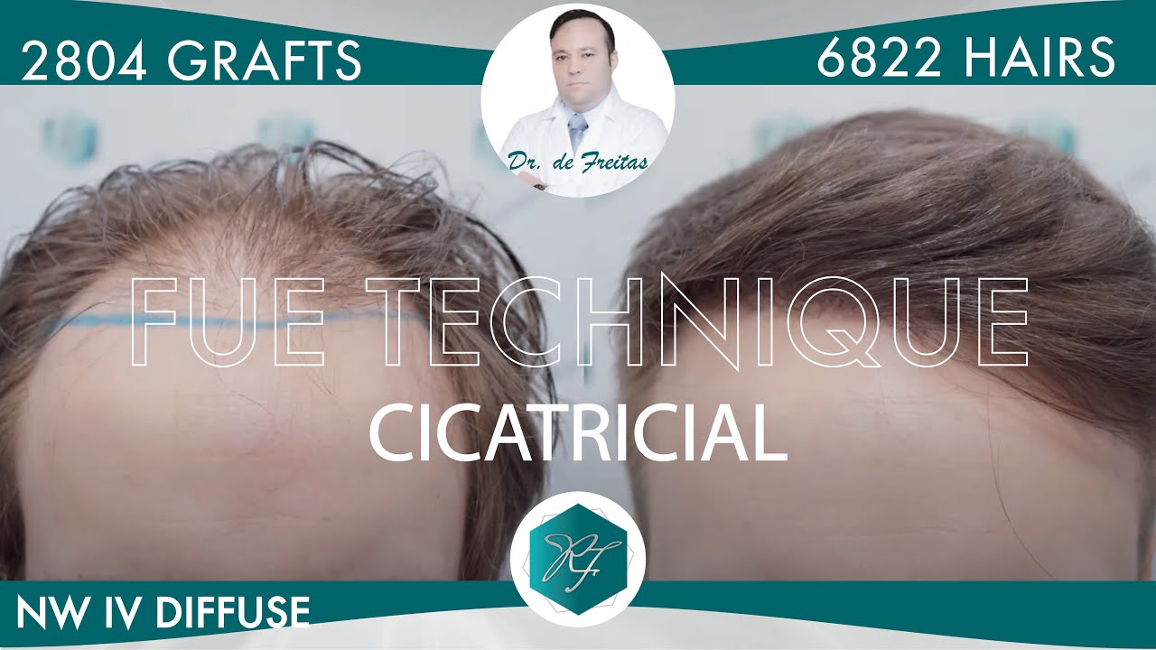 Alopecia Difusa Cicatricial por LPP  – 3.097 Grafts ( 7.082 Cabellos ) – Dr. Rafael de Freitas