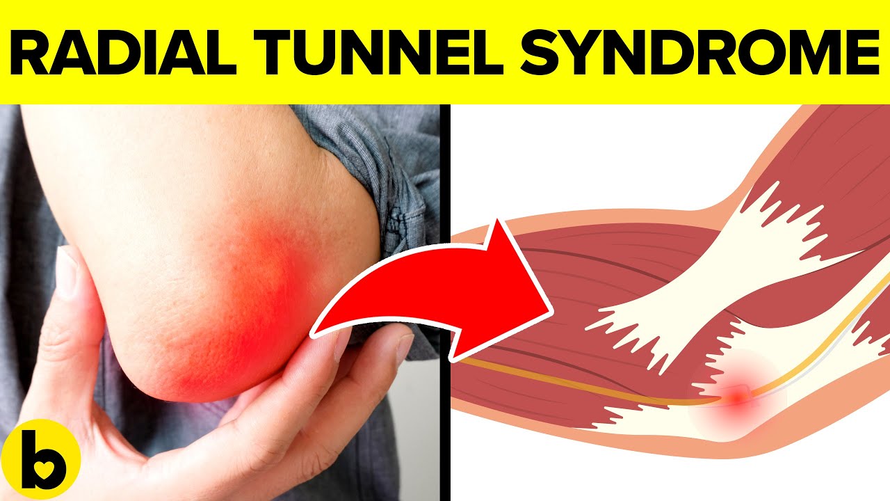 What Is Radial Tunnel Syndrome? |Symptoms, Diagnosis & Treatment