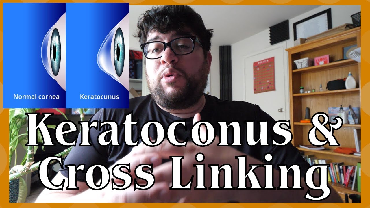 Keratoconus and Cross Linking Eye Surgical Procedure - (E.G. Why I Have Been Missing Videos) - Jack