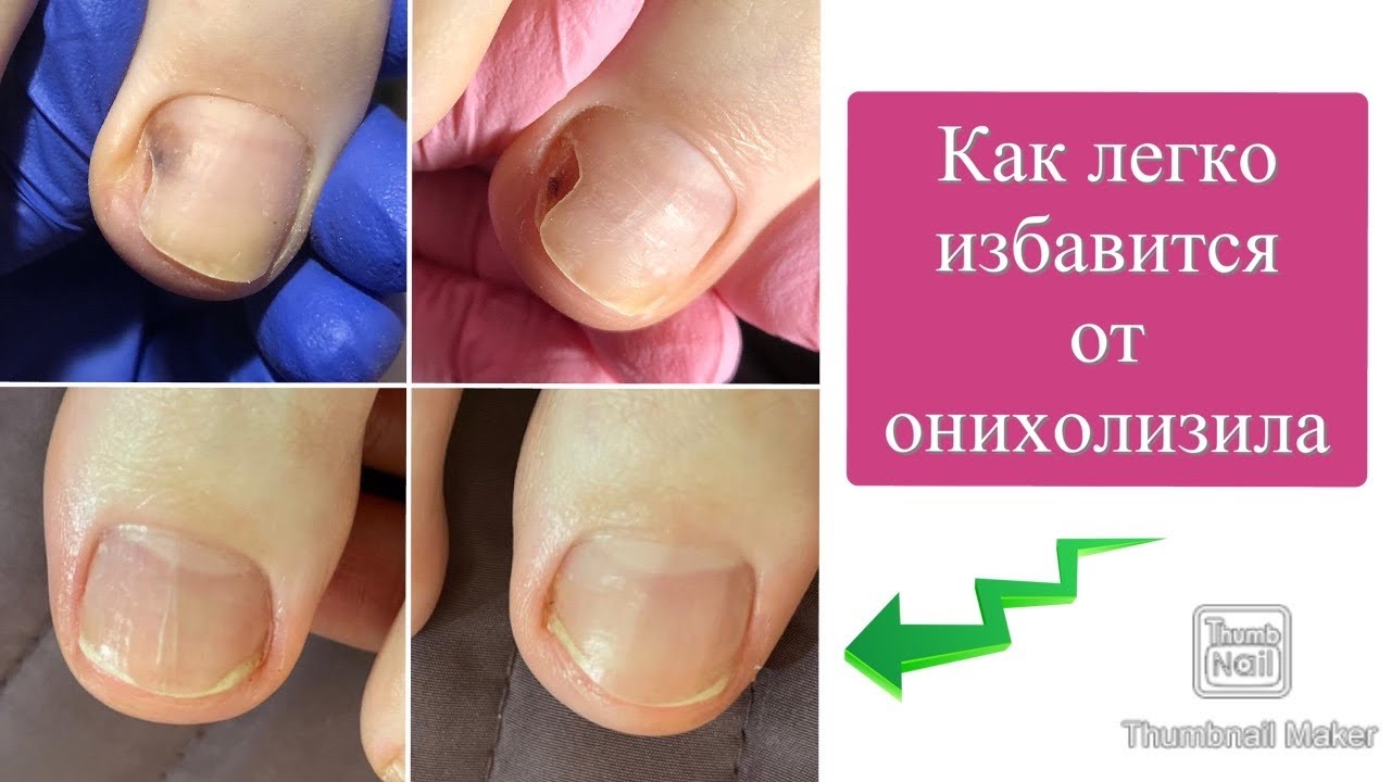 Причины онихолизиса. Как от него избавиться. Почему отслаиваются ногти. Онихолизис на ногах