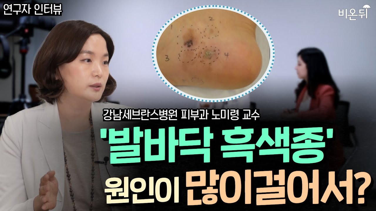 '발바닥 흑색종'의 원인 최초로 규명. 한국인에게 유독 많은 말단 악성흑색종, 그 이유는 '많이 걸어서?' (강남세브란스병원 노미령 교수)