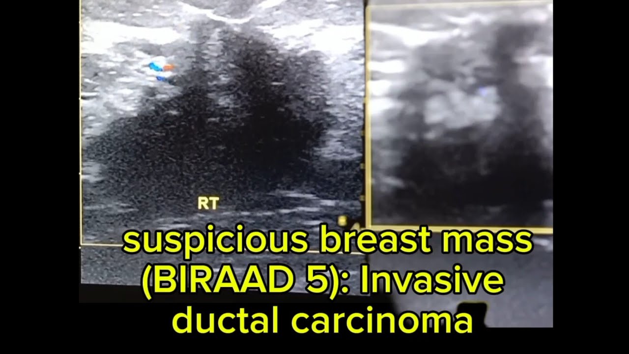 Breast mass (BIRAD 5): Invasive ductal carcinoma.