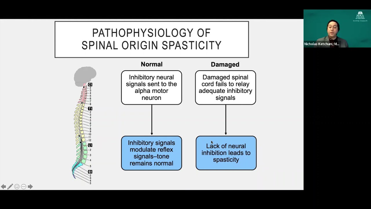 Dr. Nicholas Ketchum talks about intrathecal Baclofen Injection for Spasticity