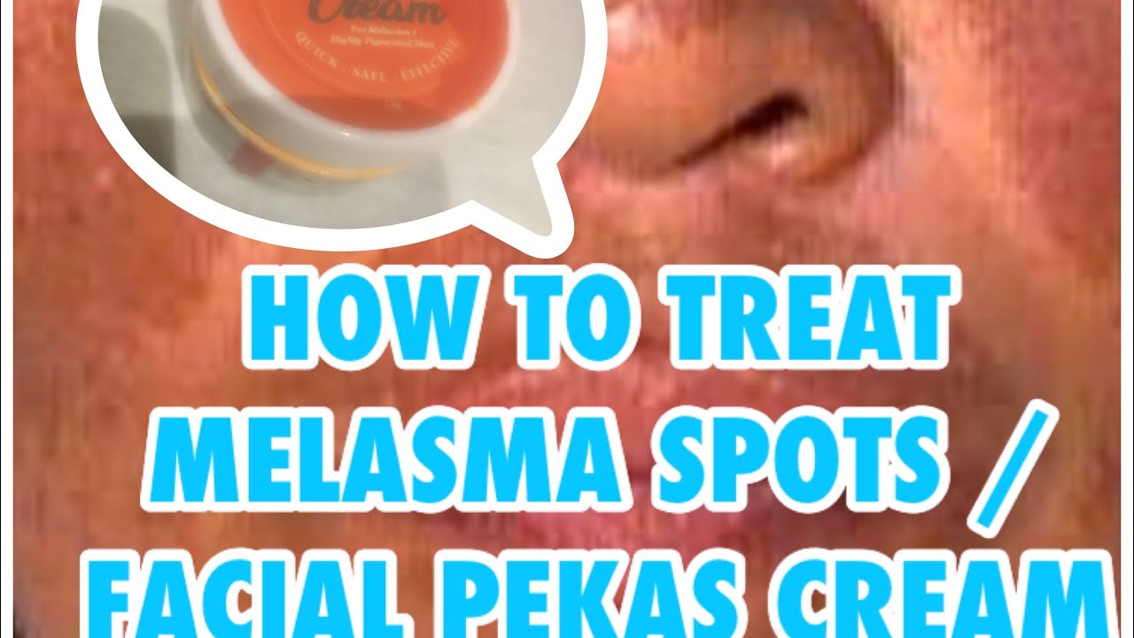 SKIN BEAUTY: HOW TO TREAT  MELASMA SPOTS/PEKAS CREAM.