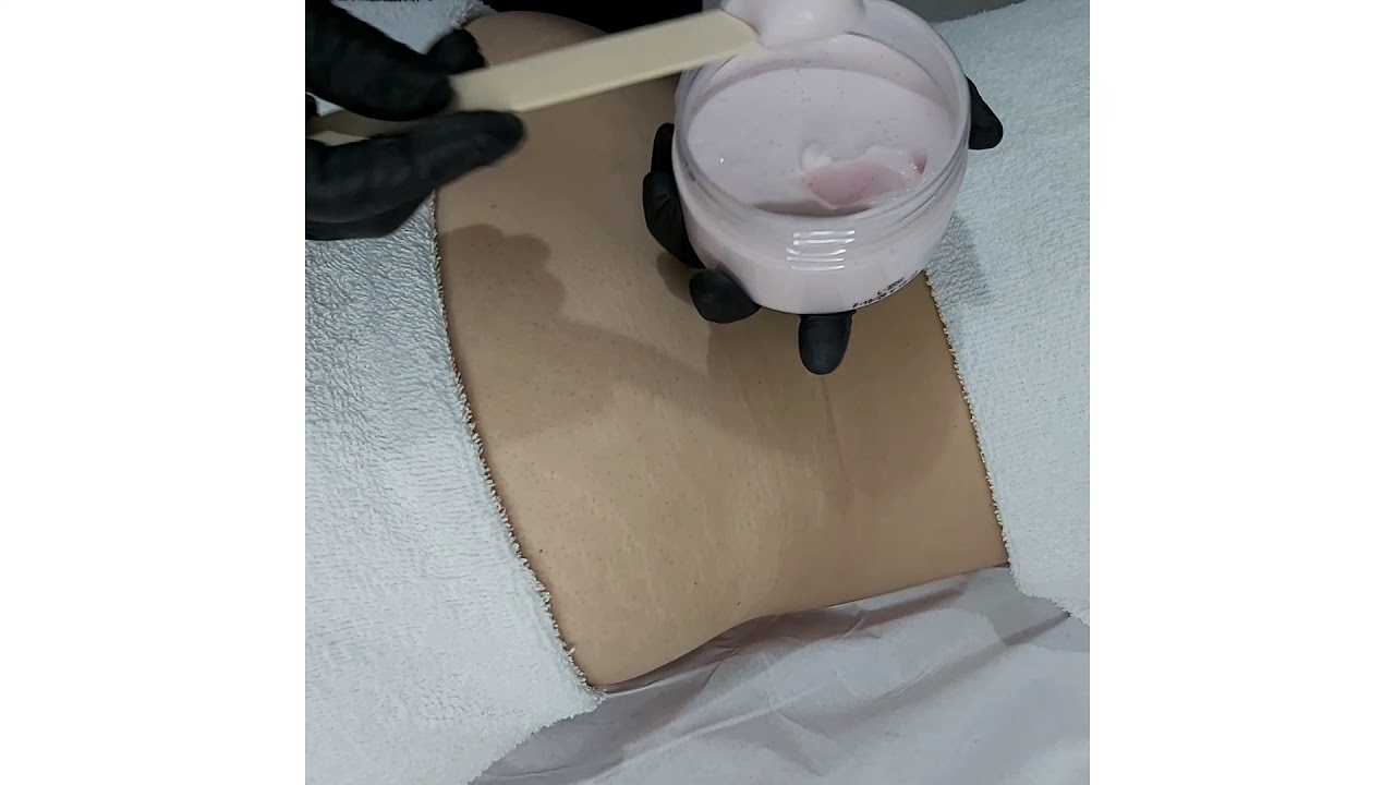 PROTOCOLO DE MICROAGULHAMENTO PARA TRATAMENTO DE ESTRIAS